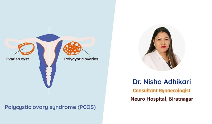 Polycystic Ovary Syndrome (PCOS)